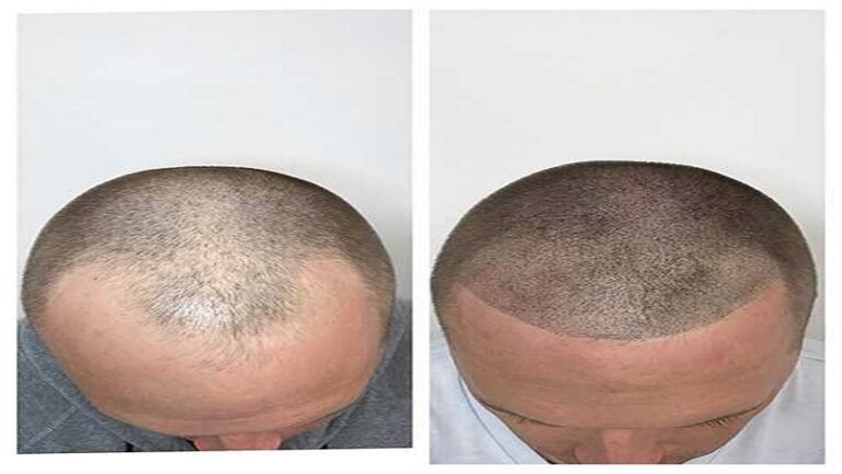 hair transplant clinic in Vadodara